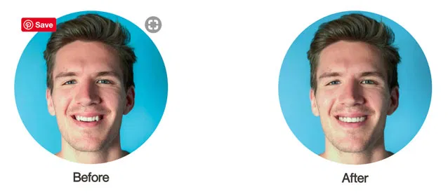 Before and After Invisalign Treatment